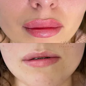 MODELOWANIE UST - Modelowanie ust 0,5 ml - zdjęcie 10